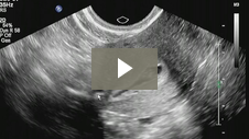 Sono HSG Procedure using ABBI: Air Bubbles Flow Through Fallopian Tube