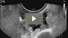 Sono HSG Procedure using ABBI: Air Bubbles Exit Fimbria